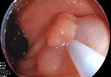 平らなポリープを注射でもりあげる